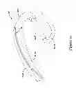 Fig. 28 - Epicardial clip