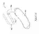 Fig. 29 - Epicardial clip