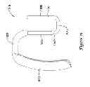 Fig. 30 - Epicardial clip