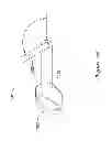 Fig. 35 - Epicardial clip