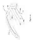Fig. 41 - Epicardial clip