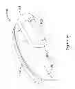 Fig. 42 - Epicardial clip