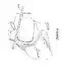 Fig. 55 - Epicardial clip