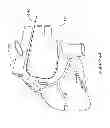 Fig. 56 - Epicardial clip