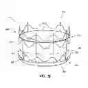 Fig. 33 - Vascular implant