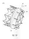 Fig. 35 - Vascular implant