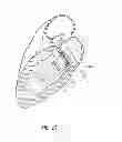 Fig. 37 - Vascular implant