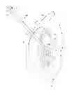 Fig. 08 - Capsule expander devices, systems, and methods for inhibiting capsular opacification and stabilizing the capsule