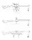 Fig. 02 - Extra-articular implantable mechanical energy absorbing systems and implantation method