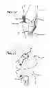 Fig. 07 - Extra-articular implantable mechanical energy absorbing systems and implantation method