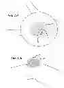 Fig. 10 - Extra-articular implantable mechanical energy absorbing systems and implantation method
