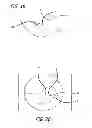 Fig. 12 - Extra-articular implantable mechanical energy absorbing systems and implantation method
