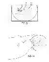 Fig. 13 - Extra-articular implantable mechanical energy absorbing systems and implantation method
