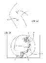 Fig. 14 - Extra-articular implantable mechanical energy absorbing systems and implantation method