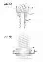 Fig. 15 - Extra-articular implantable mechanical energy absorbing systems and implantation method