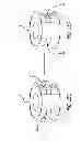 Fig. 16 - Extra-articular implantable mechanical energy absorbing systems and implantation method