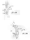 Fig. 17 - Extra-articular implantable mechanical energy absorbing systems and implantation method