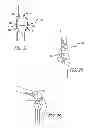 Fig. 18 - Extra-articular implantable mechanical energy absorbing systems and implantation method
