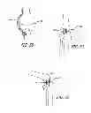 Fig. 19 - Extra-articular implantable mechanical energy absorbing systems and implantation method