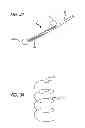 Fig. 20 - Extra-articular implantable mechanical energy absorbing systems and implantation method