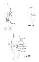 Fig. 26 - Extra-articular implantable mechanical energy absorbing systems and implantation method
