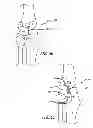 Fig. 27 - Extra-articular implantable mechanical energy absorbing systems and implantation method