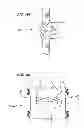 Fig. 29 - Extra-articular implantable mechanical energy absorbing systems and implantation method