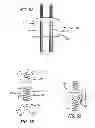 Fig. 30 - Extra-articular implantable mechanical energy absorbing systems and implantation method