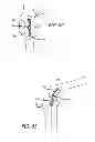 Fig. 31 - Extra-articular implantable mechanical energy absorbing systems and implantation method