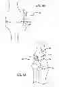 Fig. 32 - Extra-articular implantable mechanical energy absorbing systems and implantation method