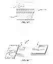 Fig. 34 - Extra-articular implantable mechanical energy absorbing systems and implantation method