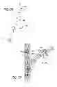 Fig. 35 - Extra-articular implantable mechanical energy absorbing systems and implantation method