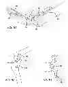Fig. 40 - Extra-articular implantable mechanical energy absorbing systems and implantation method