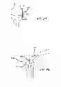 Fig. 41 - Extra-articular implantable mechanical energy absorbing systems and implantation method