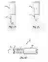 Fig. 44 - Extra-articular implantable mechanical energy absorbing systems and implantation method