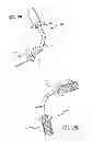 Fig. 46 - Extra-articular implantable mechanical energy absorbing systems and implantation method