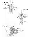 Fig. 47 - Extra-articular implantable mechanical energy absorbing systems and implantation method