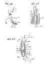 Fig. 49 - Extra-articular implantable mechanical energy absorbing systems and implantation method
