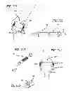 Fig. 50 - Extra-articular implantable mechanical energy absorbing systems and implantation method