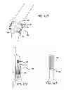Fig. 51 - Extra-articular implantable mechanical energy absorbing systems and implantation method
