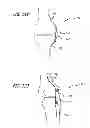Fig. 52 - Extra-articular implantable mechanical energy absorbing systems and implantation method