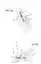 Fig. 54 - Extra-articular implantable mechanical energy absorbing systems and implantation method