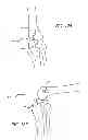 Fig. 55 - Extra-articular implantable mechanical energy absorbing systems and implantation method