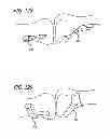 Fig. 56 - Extra-articular implantable mechanical energy absorbing systems and implantation method