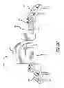 Fig. 57 - Extra-articular implantable mechanical energy absorbing systems and implantation method