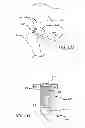 Fig. 59 - Extra-articular implantable mechanical energy absorbing systems and implantation method
