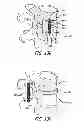 Fig. 61 - Extra-articular implantable mechanical energy absorbing systems and implantation method