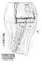 Fig. 05 - Nebulizer having replaceable nozzle assembly and suction line