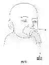 Fig. 19 - Nebulizer having replaceable nozzle assembly and suction line
