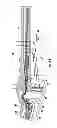 Fig. 34 - Nebulizer having replaceable nozzle assembly and suction line
